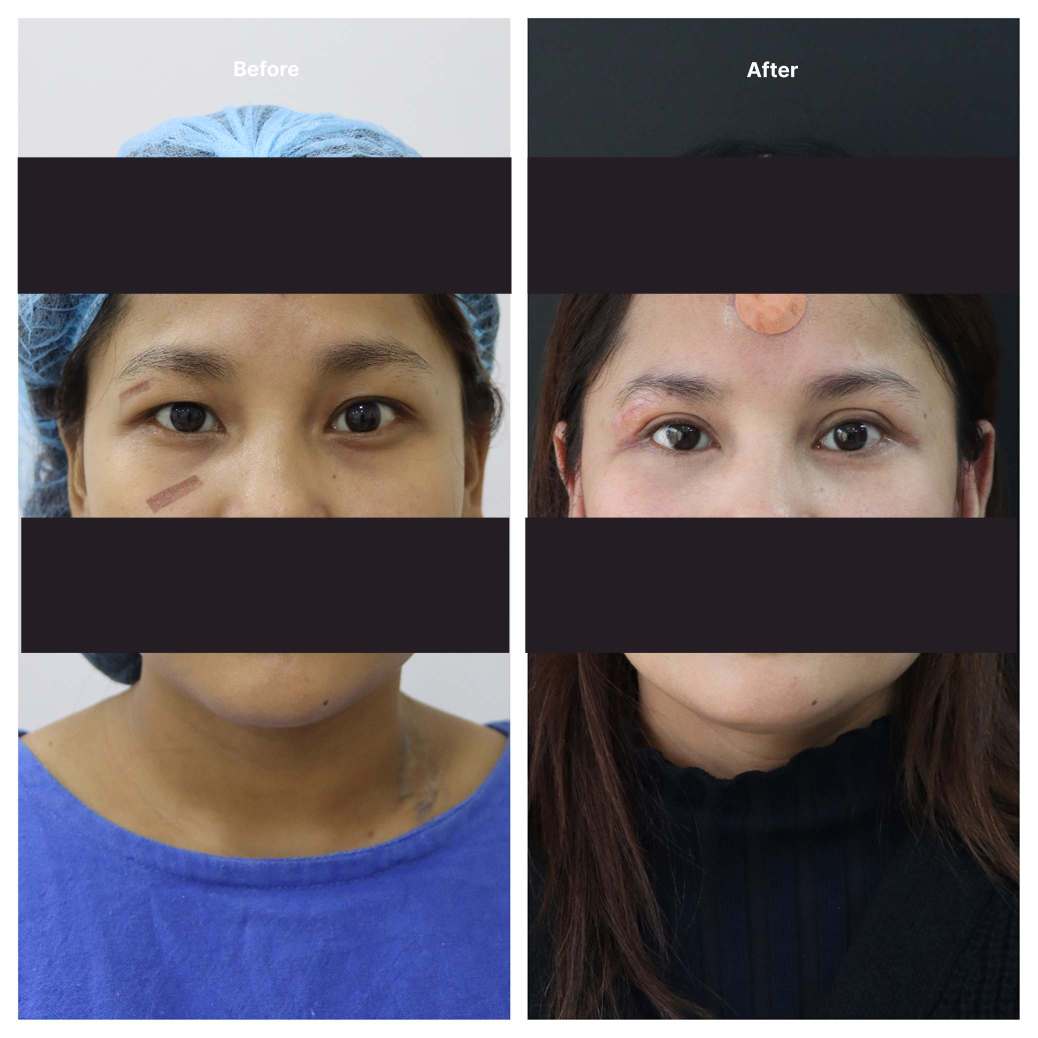 Eyelid Surgery KOQ10